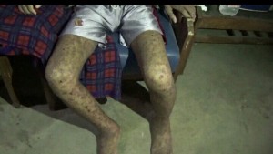 SATU KELUARGA MISKIN KENA GATAL-GATAL AKIBAT TIDUR DI KASUR BASAH YANG KEHUJANAN